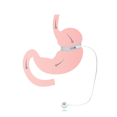 Gastric Banding