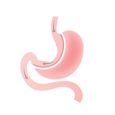 Gastric Sleeve