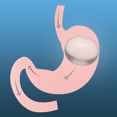 ORBERA™ Gastric Balloon