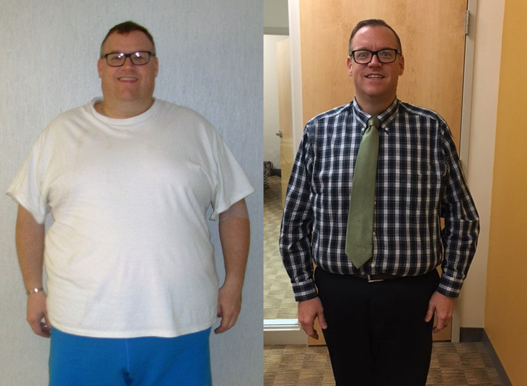 Gastric Sleeve Before and After Photos