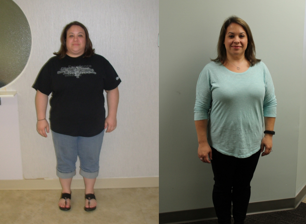 Jennifer's Weight Loss Transformation | St Louis Bariatrics