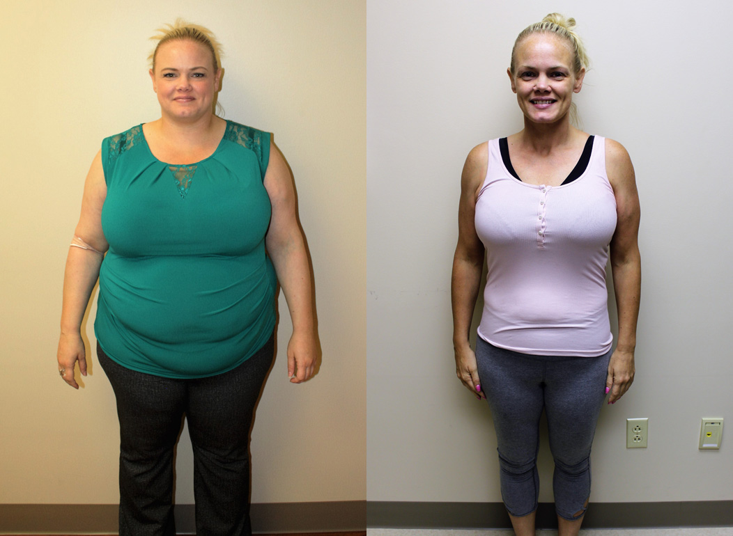 Gastric Sleeve Before And After In St Louis St Louis Bariatrics