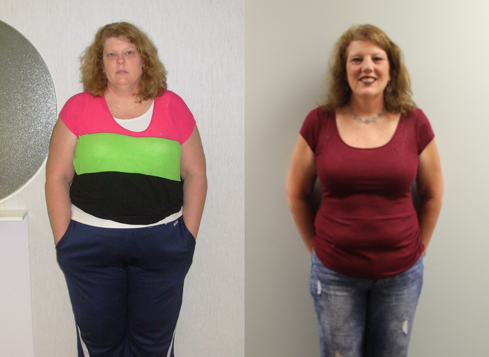 Jeanna's Gastric Sleeve Transformation | St Louis Bariatrics