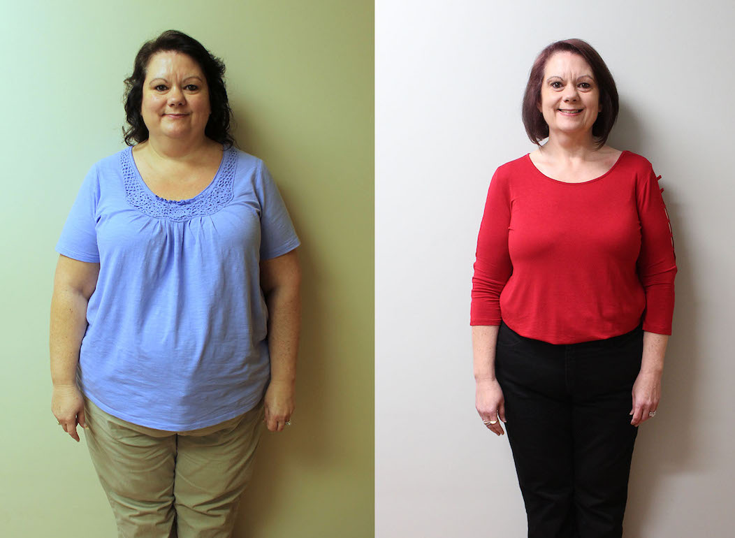 Weight Loss Surgery Before and After | Robin | St Louis Bariatrics