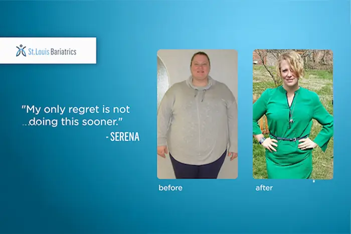 serena before and after bariatric surgery