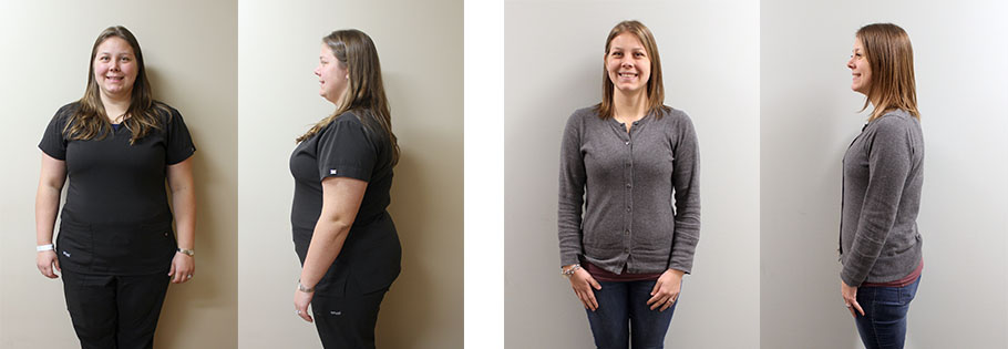 Casie's gastric sleeve before and after