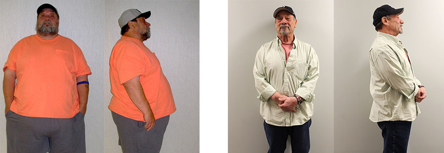 John's gastric sleeve success