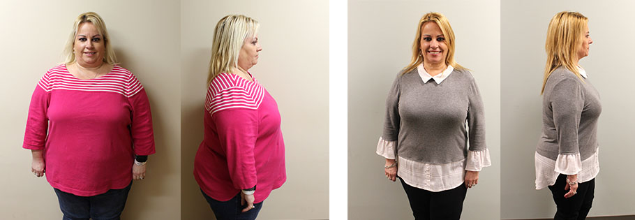 Julie's gastric sleeve success