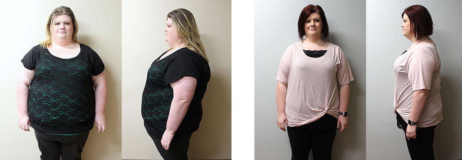 Nichole's gastric sleeve transformation