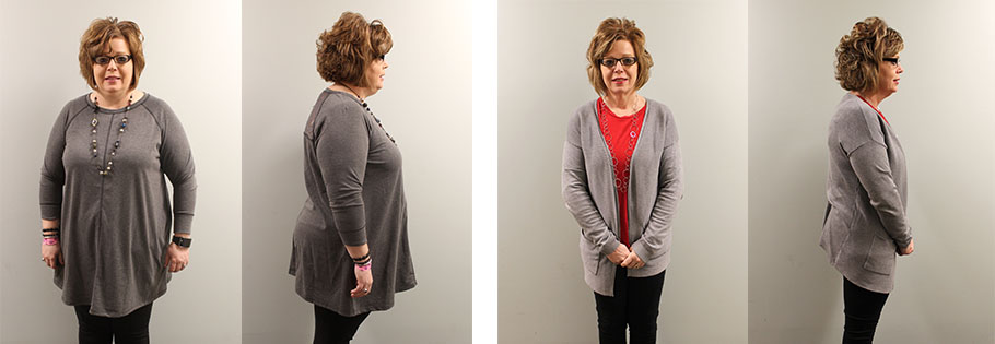 Susan's gastric sleeve before and after
