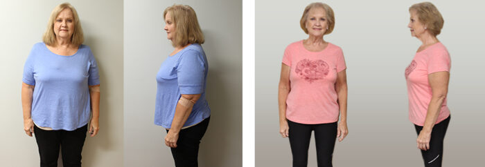 Denise's Weight Loss Transformation | St Louis Bariatrics