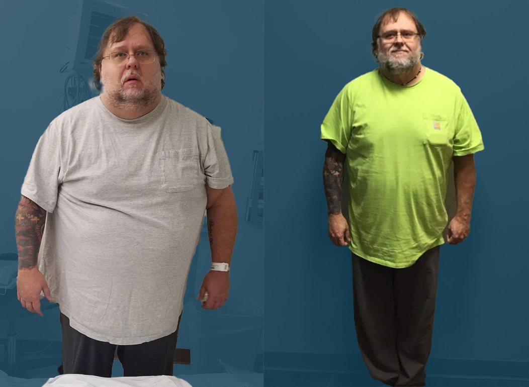 STLB patient before and after