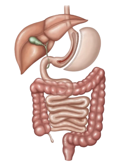 gastric sleeve illustration