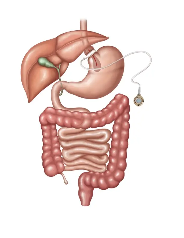 gastric band illustration
