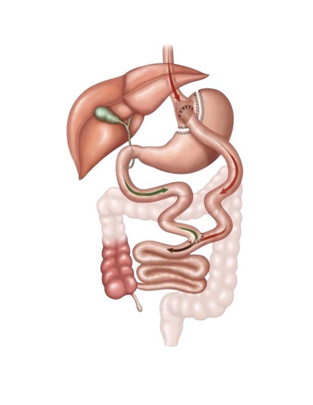 gastric bypass illustration