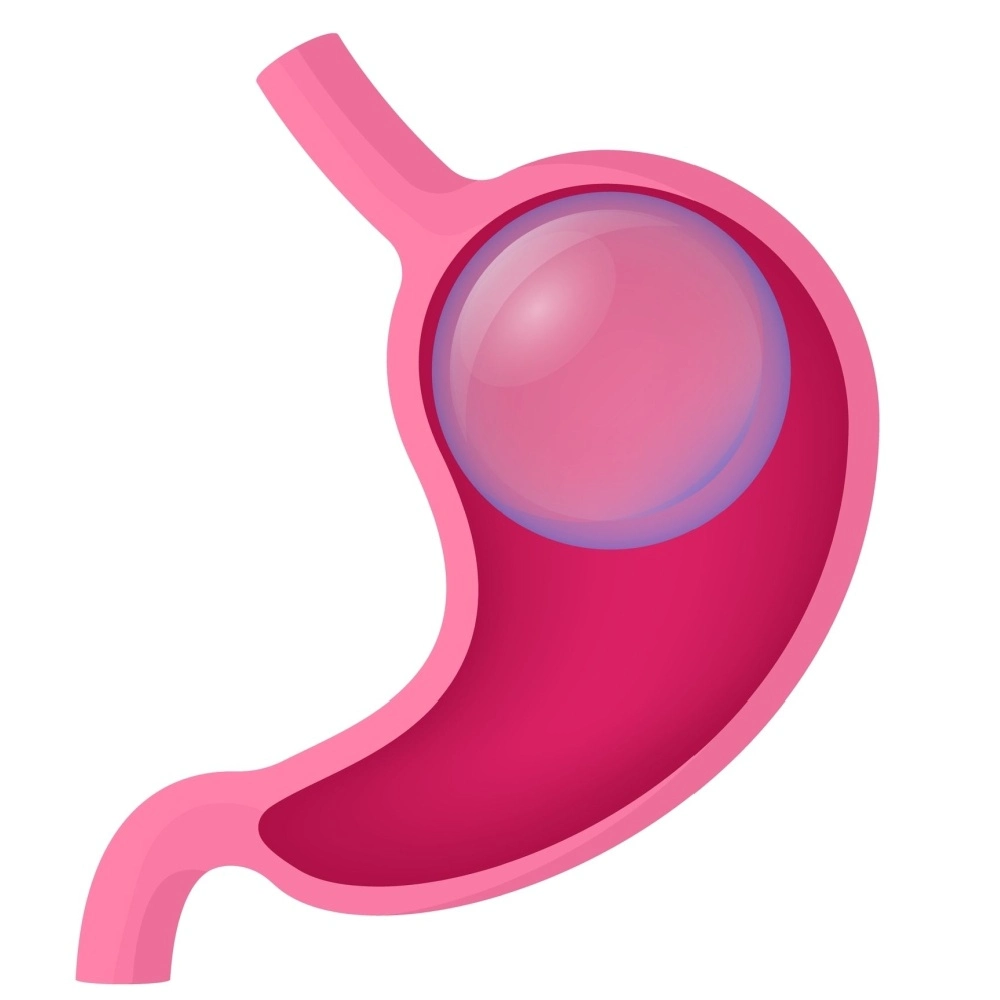 gastric balloon illustration