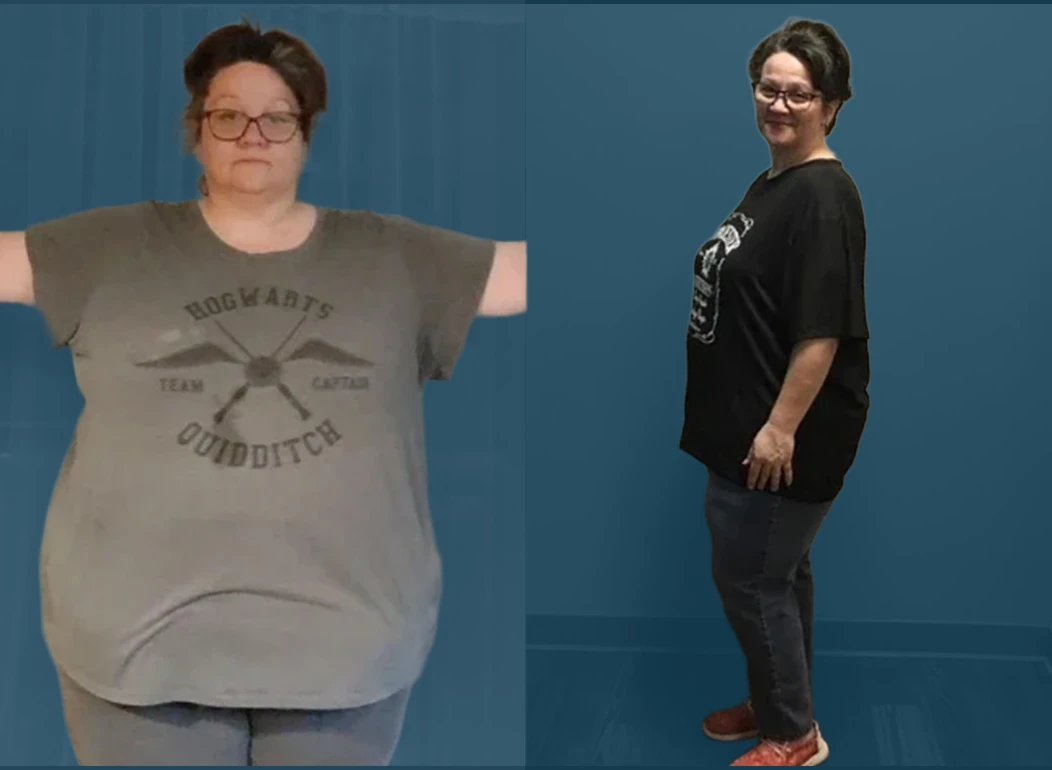 Sarah, a real St. Louis Bariatrics patient